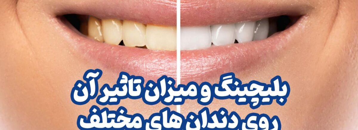 بلیچینگ و میزان تاثیر آن روی دندان های مختلف