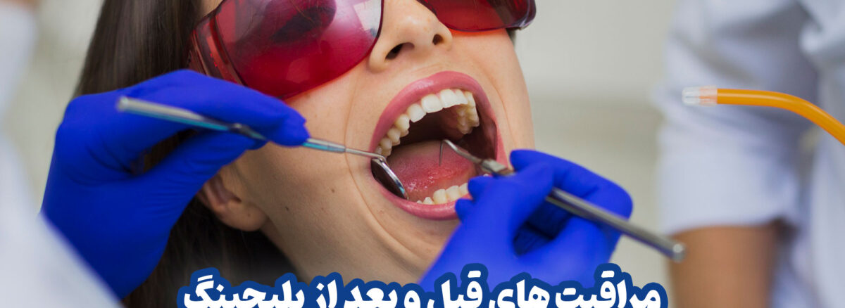 مراقبت های قبل و بعد از بلیچینگ دندان