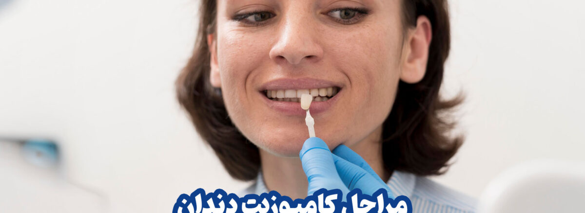 مراحل کامل کامپوزیت دندان